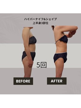 コリ チル(Kori Chill)/【ハイパーナイフ＆シェイプ】