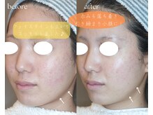 岩川治療院/ニキビによる赤みの減少♪