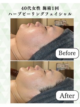 シーフェイス 横浜店(SEE FACE)/毛穴肌質改善ハーブピーリング