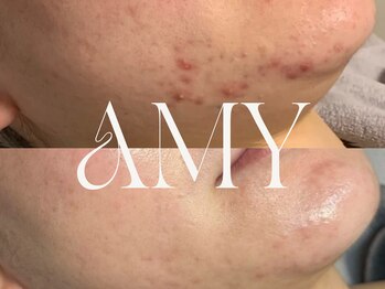 エイミー(Amy)/-【乳酸/ピーリング】-