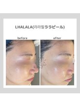 韓国肌管理室pom.haneul【ポムハヌル】LDM/インモード/ララピール/プラピール福岡天神/韓国肌管理室