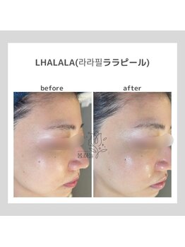 韓国肌管理室pom.haneul【ポムハヌル】LDM/インモード/ララピール/プラピール福岡天神/韓国肌管理室