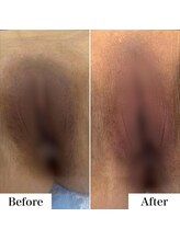 ルネル(Lunelle)/韓国式メラニンケア《Iライン》