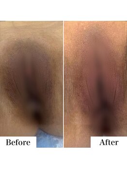 ルネル(Lunelle)/韓国式メラニンケア《Iライン》