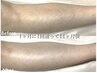【初回女性】毛穴レスが叶う全身脱毛（顔・VIOなし）都度払い￥8,000