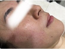 アンドユー ヨコハマ(&U Yokohama)/クリスティーナ施術前