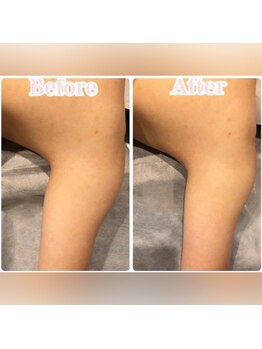 カンコルギセラピー 西新宿店 フレッシュタイム(KAN)/二の腕ケア