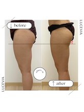 ルセヴィア(LUCEVIA)/痩身エステ（半身/下半身）