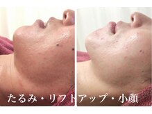 リリアーナ(LILIANA)の雰囲気（たるみ予防/リフトアップ/小顔/二重顎/毛穴/浮腫み/ニキビ改善）