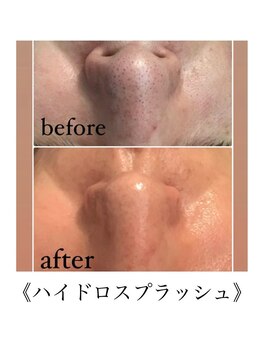 サロンドシェリ(salon de cheri)/ハイドロフェイシャル