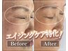 【5周年/5名限定】シミシワケア★美容鍼×インディバ美容液導入¥15000→¥5980