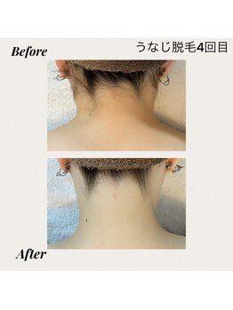 クロッシュ(Cloche)/光脱毛＆ワックス脱毛