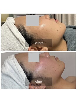 カノン(Kanon)/レモンボトルと美白でツヤツヤ肌