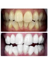 ラブホワイトニング 恵比寿店(LOVEホワイトニング)/デラックスコース