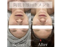 カルナ(CARNA)/陶肌トリートメント★