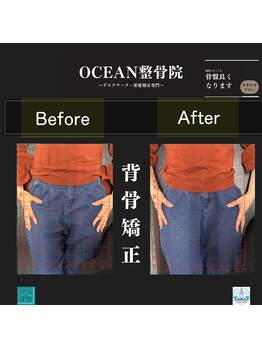 オーシャン整骨院(OCEAN整骨院)/背骨矯正の骨盤ビフォーアフター