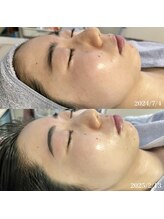 リリアス(RILLIAS)/くすみケア