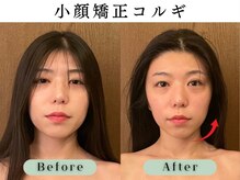 スイスパ 恵比寿(翠SUI SPA)/【小顔矯正コルギ】Before/After