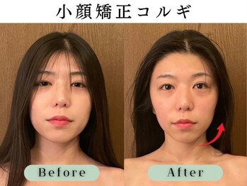 スイスパ 恵比寿(翠SUI SPA)/【小顔矯正コルギ】Before/After