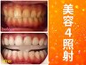 【会員/回数券】8分×4回美容セルフホワイトニング