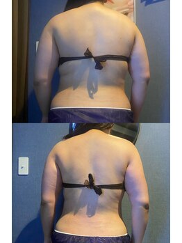 優来 神田店/肩甲骨施術の例