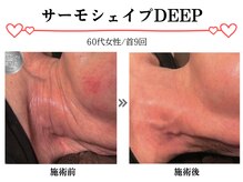 スパイア(SPIRE)/サーモシェイプお首★