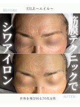 エイル(EILE)/症例