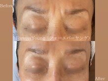 ミー(Me)の雰囲気(《フォーエバーヤング》シワ、リフトアップ、たるみ、ハリ、ツヤ)