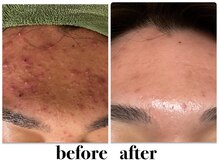 キュート 川越店(Cute)/ハーブピーリング【ハード】