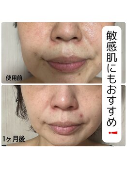 アクシア ビューティー サロン(AXSIA)/【CELLNAGE 】Before After