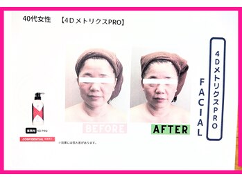 フレクシー/４D　beforeafter