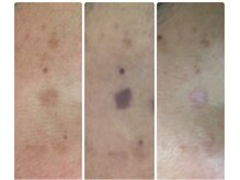 パーム(Palm)/背面からもアプローチ