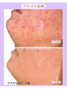 ホリホック/プラズマ症例