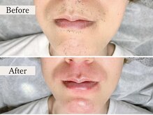 ルミナ(LUMINA)/髭脱毛