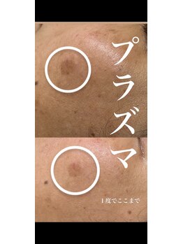 ウィンウィン 新山口店(Win Win)/シミケア