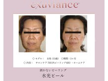エテル(eter)の雰囲気(繰り返すニキビ・くすみ・乾燥・シミ・シワ・赤みの肌質改善)