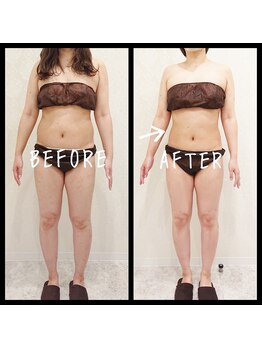 デジール(DESIR)/次世代痩身マシン8000shot お腹