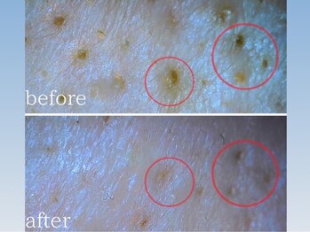 ハーシークレット(Her secret)/ハイドラ毛穴洗浄