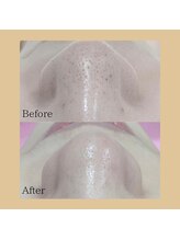 チャイディー(Chai Dee)/毛穴洗浄ハイドラ(2)