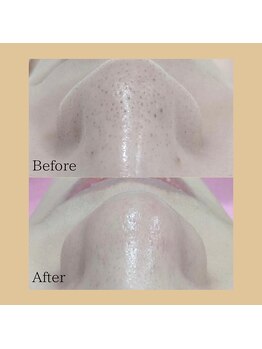 チャイディー(Chai Dee)/毛穴洗浄ハイドラ(2)