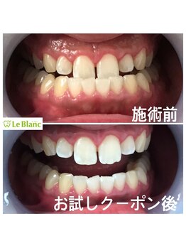 ルブラン 奈良店(Le Blanc)/見られていますよ!歯!