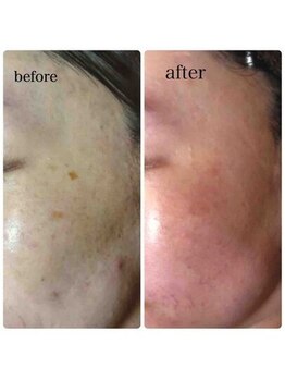 ブランシェ 富山店 × 椿/シミケア お客様