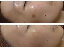 ブランシェ 金沢店 × 椿/シミケア　お客様