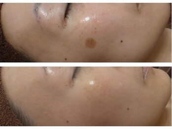 ブランシェ 金沢店 × 椿/シミケア　お客様