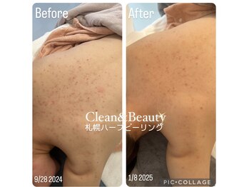 クリーンアンドビューティ 札幌(Clean&Beauty)/背中のニキビケアに♪