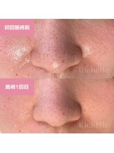 リシェル(Richelle)/【GREENPEEL5days】