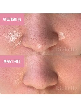 リシェル(Richelle)/【GREENPEEL5days】