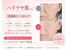 フロウ(Froh)の雰囲気（施術後、約2週間でハリ艶感アップ♪）