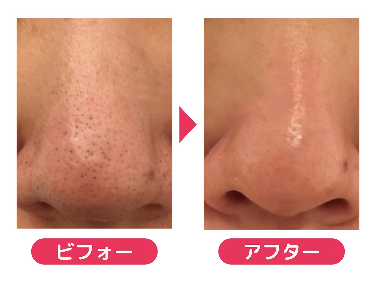 香川県で毛穴ケアが人気のエステサロン｜ホットペッパービューティー