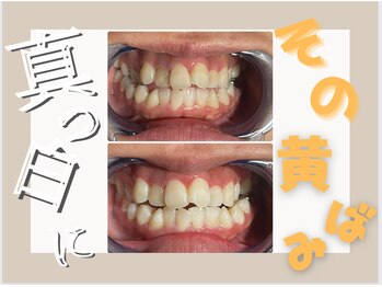 ア クイーユ(Accueil)/あなたの歯、黄ばんでない?